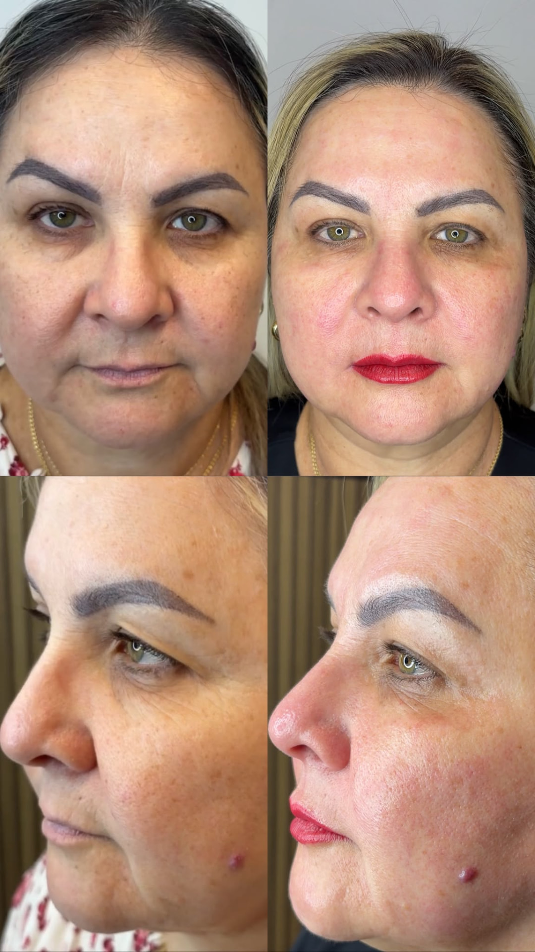 Antes y después de tratamiento Fibroblast de efecto lifting facial