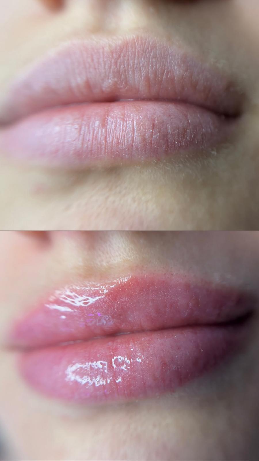 Antes y después de tratamiento Hidralips de hidratación labial