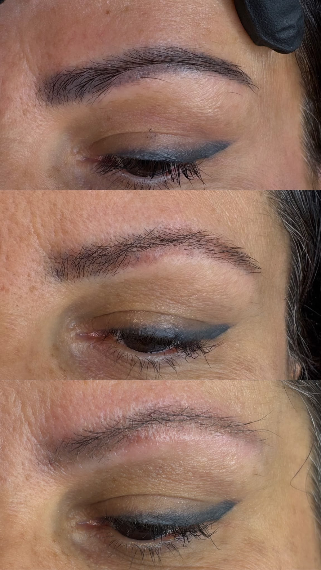 Proceso real de eliminación láser de micropigmentación de cejas