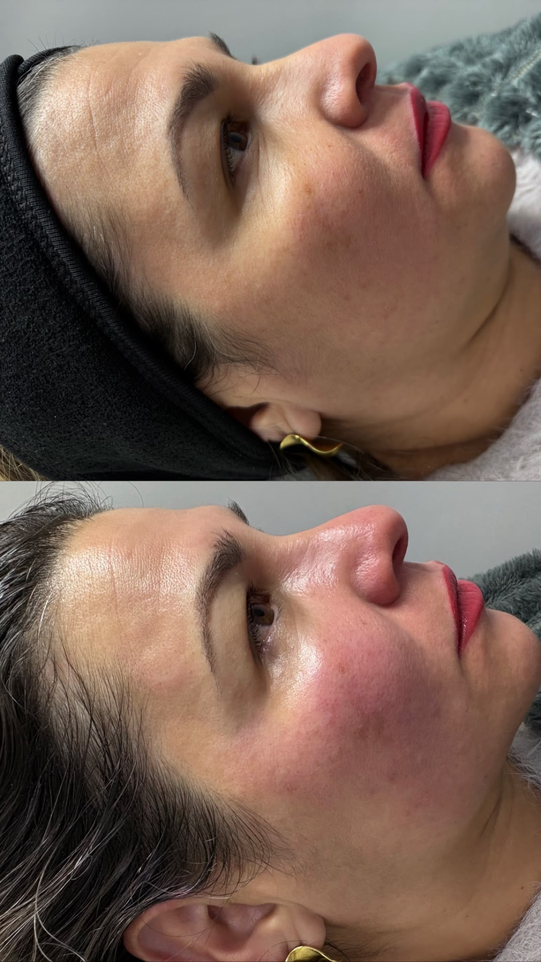 Antes y después de tratamiento facial con Dermapen