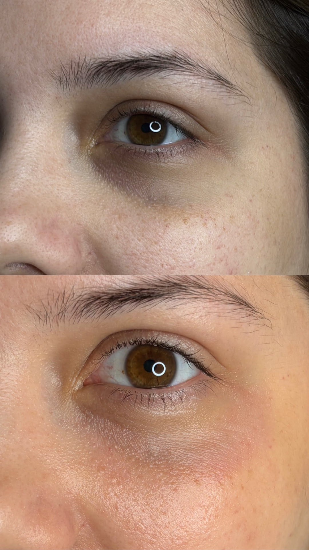 Antes y después de tratamiento de ojeras en Madrid